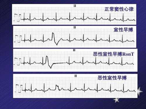 早搏为什么躺下后频发（出现早搏就一辈子无法治愈吗）