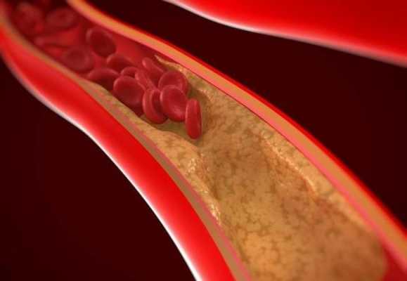 人的血管怎么会堵呢