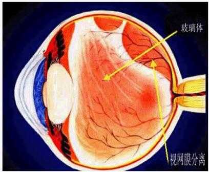 为什么会玻璃体脱离,为什么会出现玻璃体后脱离 