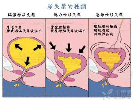 喝酒引起的尿潴留