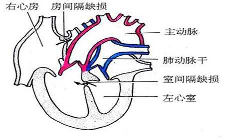  为什么会得房间隔缺损「房间隔缺损为什么容易呼吸道感染」