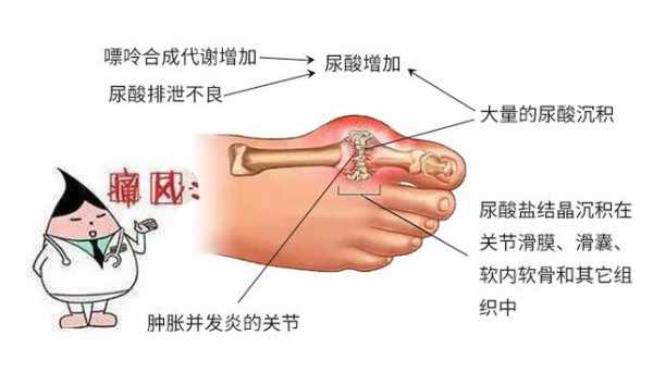 痛风为什么会突然发作（痛风突然犯了）