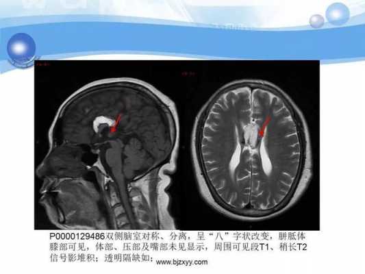 为什么脑胼胝发育不良（胼胝体发育不良伴脑回畸形）