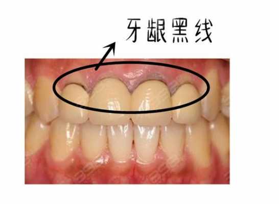 烤瓷牙刚做好就有黑线-烤瓷牙为什么有黑线