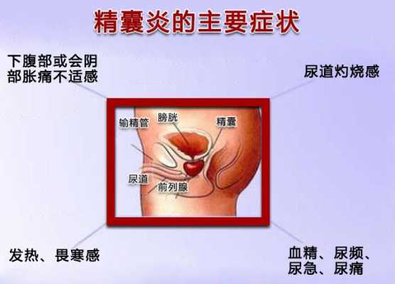 为什么会有精囊炎和囊肿-为什么会有精囊炎