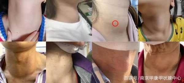  碘131为什么会脖子肿「碘131后脖子肿胀」