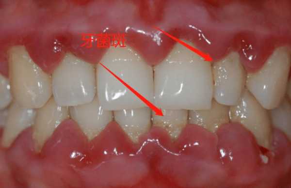  牙齿面为什么有划痕「牙齿有划痕能自愈吗」