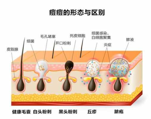 粉刺痘痘为什么反复长痘痘 粉刺痘痘为什么反复长