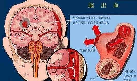 脑溢血为什么会死（脑溢血为什么死的那么快）