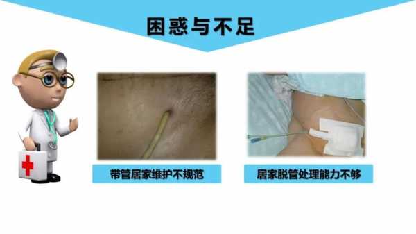 膀胱造瘘为什么总出血_膀胱造瘘后出血量大怎么办