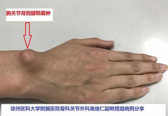 腱鞘囊肿为什么这么硬 腱鞘囊肿为什么那么硬